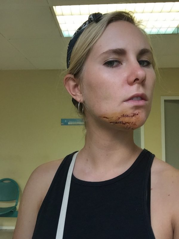 Zoe with eleven stitches in her chin