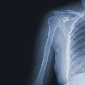 X-ray of shoulder, ribs, and spine